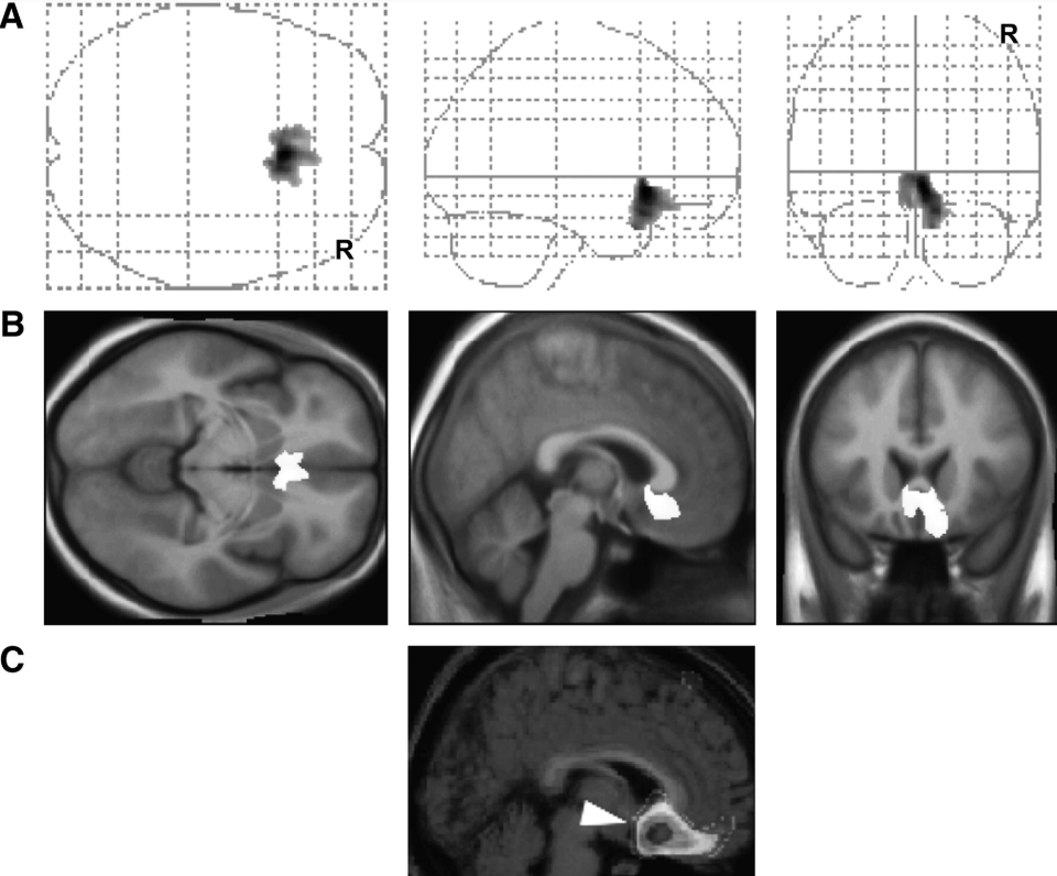 Structural Brain Changes Study Help Us Understand More About Tinnitus